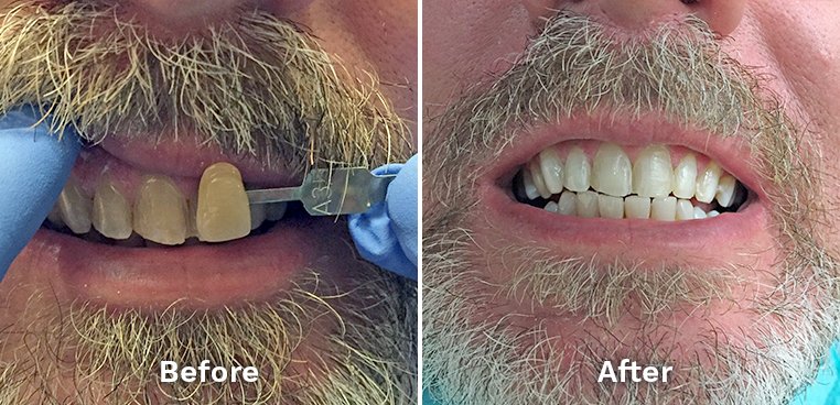 Kor teeth whitening before and after photo