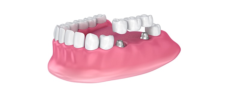 illustration of dental bridge attaching to two dental implants