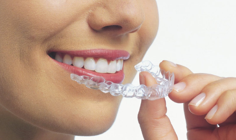woman inserting invisalign clear aligner tray to straighten her teeth