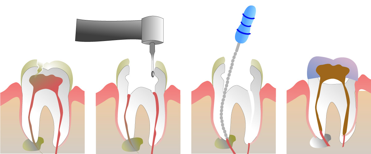 Illustration of four step root canal therapy