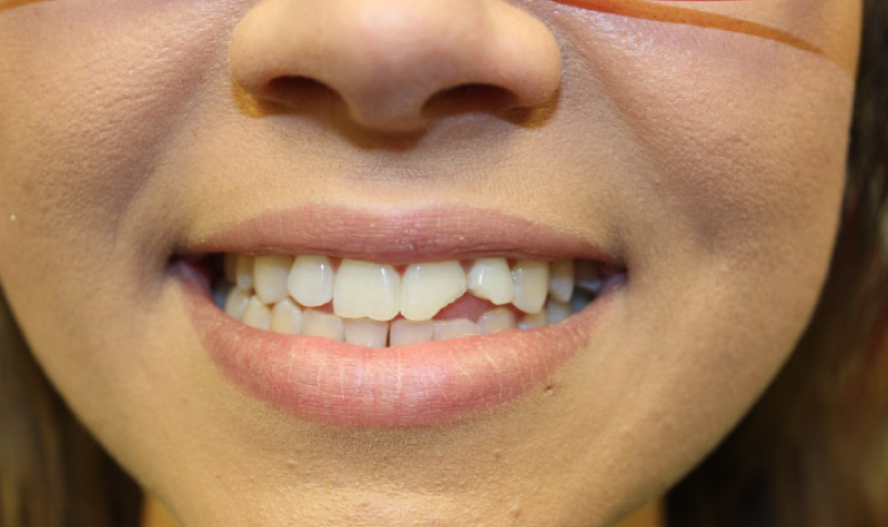 Closeup of a smile with a chipped tooth