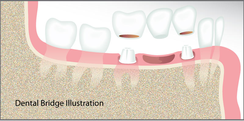 Illustration of a dental bridge