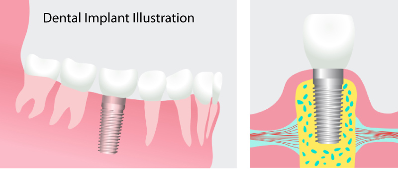 Illustration of a dental implant