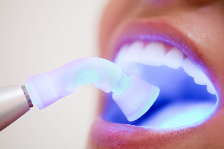 Close up of an open mouth where the blue light is being used to detect early signs of oral cancer