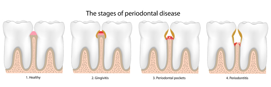 Graphic showing the stages of gum disease fromm gingivitis to periodontitis