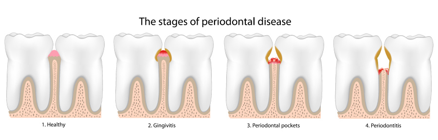 Graphic showing the stages of gum disease fromm gingivitis to periodontitis
