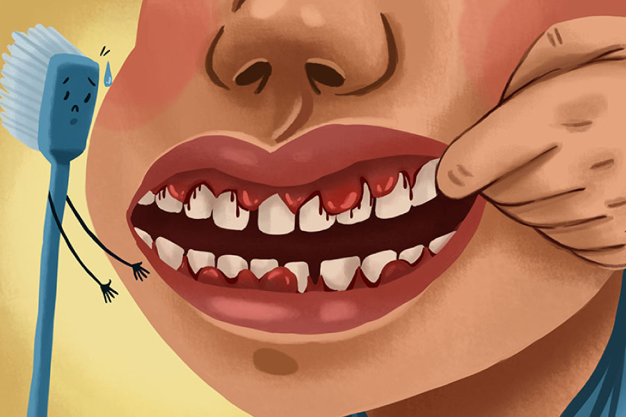 Cartoon of a mouth with bleeding gums indicating gum disease.