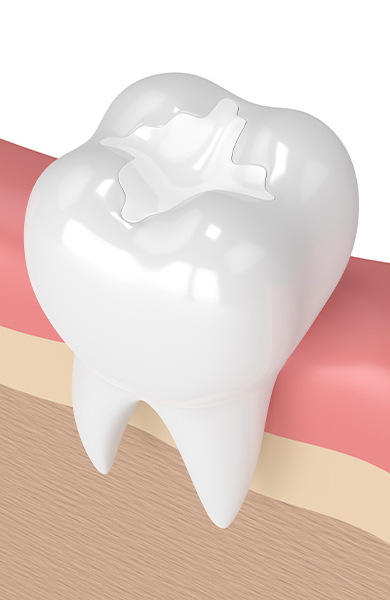 Graphic showing a dental sealant in a molar.