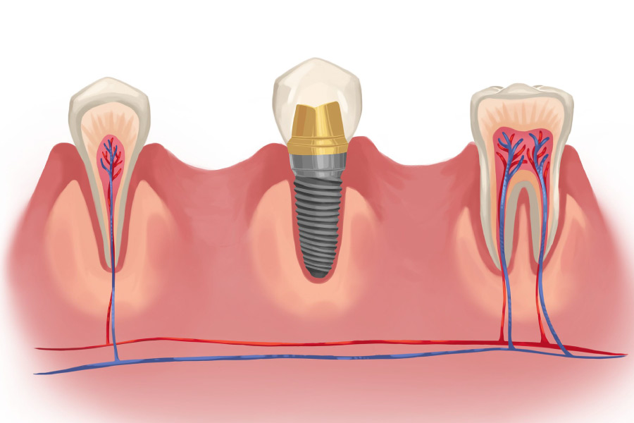 Graphic of a dental implant next to natural teeth.