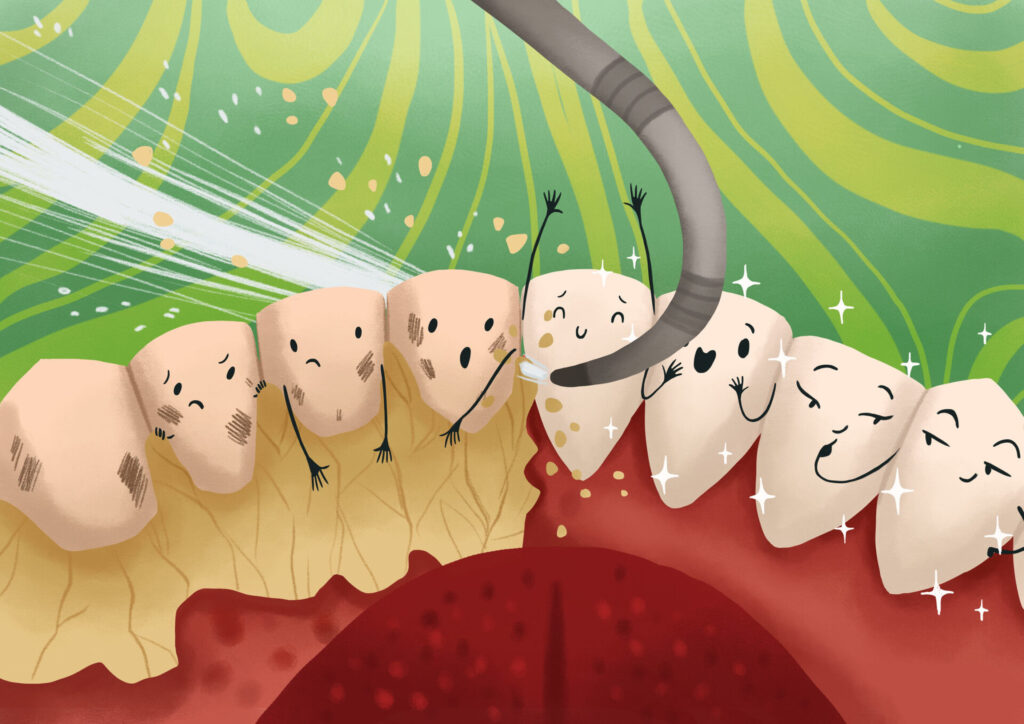 graphic illustration of dental plaque and tartar being removed during a dental cleaning